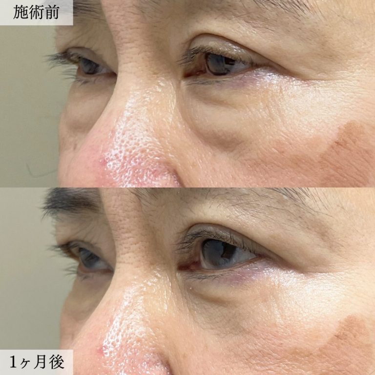 切らない目の下のクマ取り・目の下のたるみ（ふくらみ）取り(担当医:大見 貴秀 医師)の症例写真2