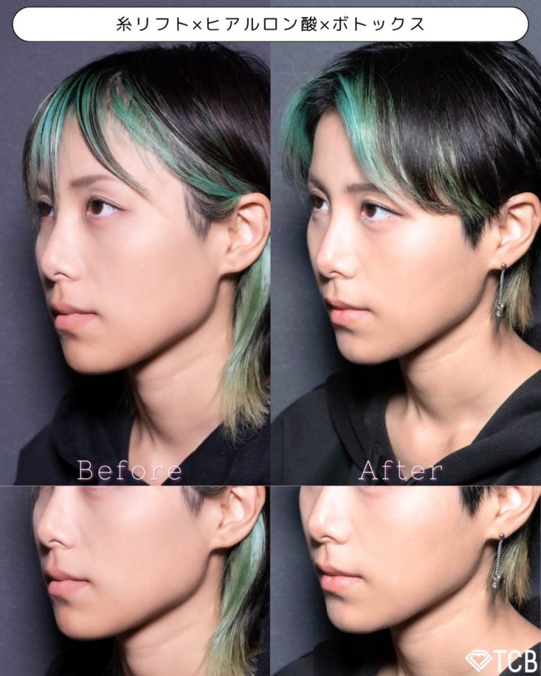 小顔美肌再生（リフトアップ）(担当医:北村 可恋 医師)の症例写真2