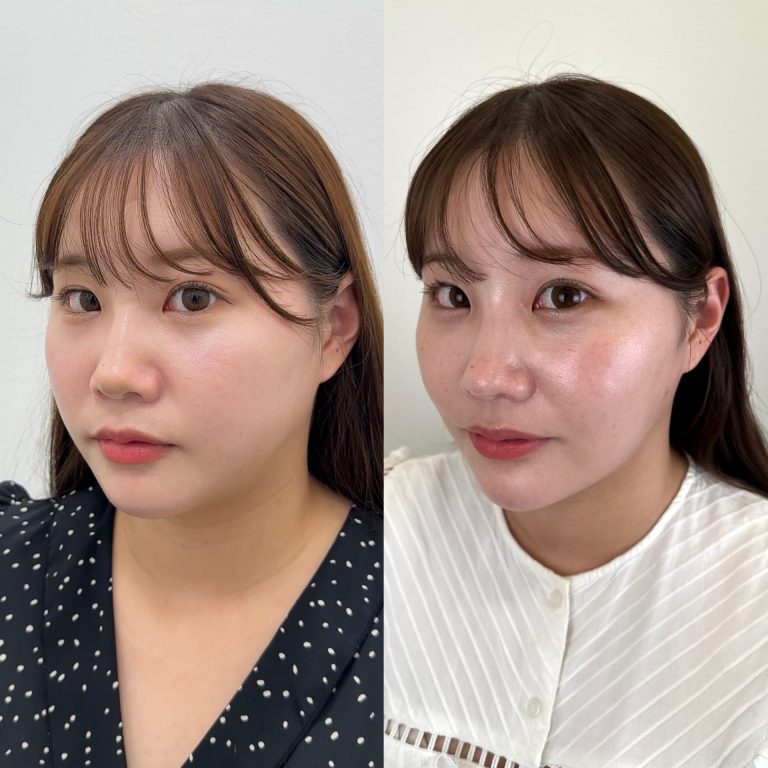 顔の脂肪吸引(担当医:富田 秀鷹 医師)の症例写真1