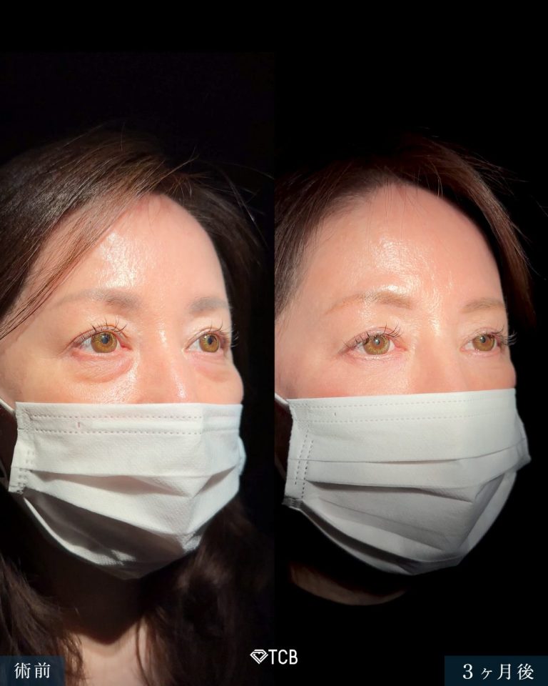 切開法による目の下のたるみ取り（下眼瞼除皺術）(担当医:向田 敦史 医師)の症例写真1