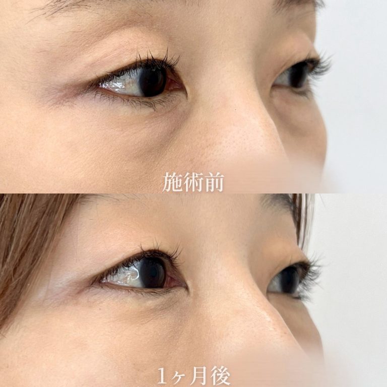 切らない目の下のクマ取り・目の下のたるみ（ふくらみ）取り(担当医:垣花 瑠美子 医師)の症例写真3