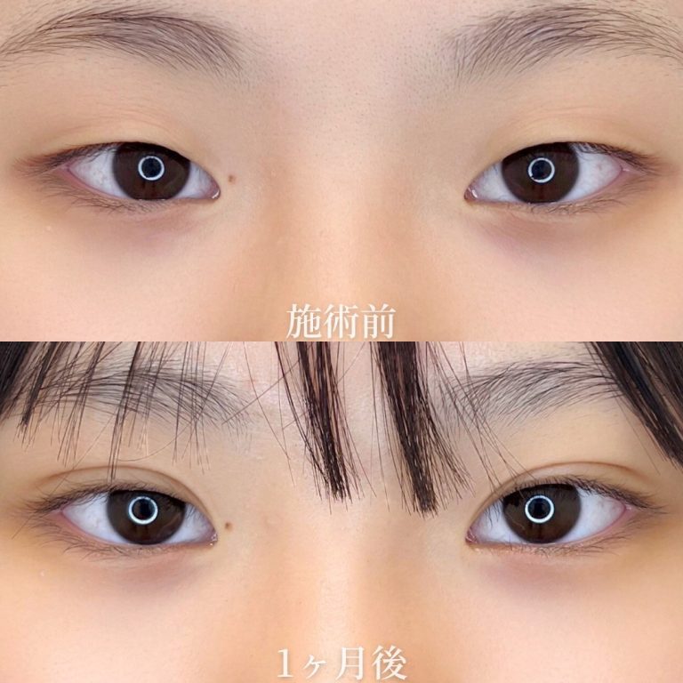 二重埋没法(担当医:垣花 瑠美子 医師)の症例写真1