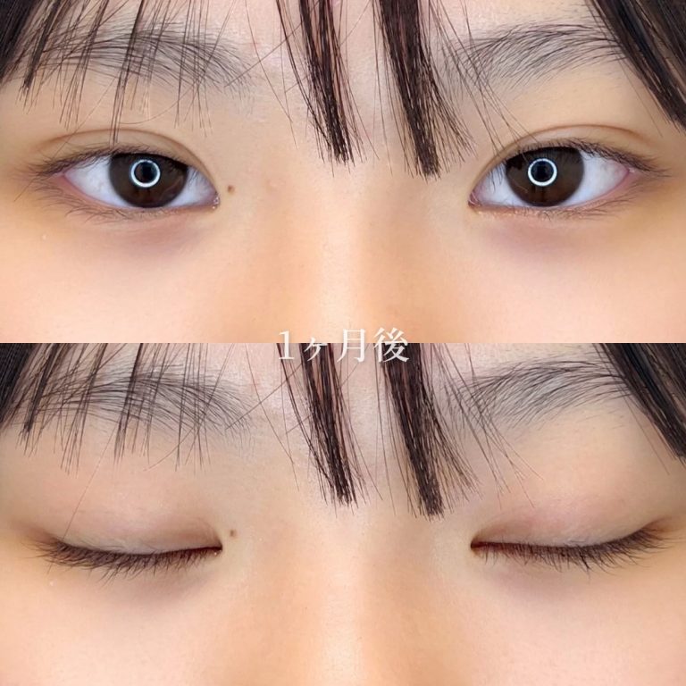 二重埋没法(担当医:垣花 瑠美子 医師)の症例写真2
