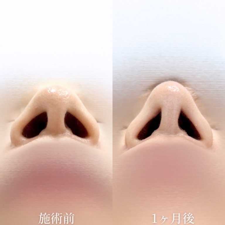 TCBメッシュ(担当医:垣花 瑠美子 医師)の症例写真2
