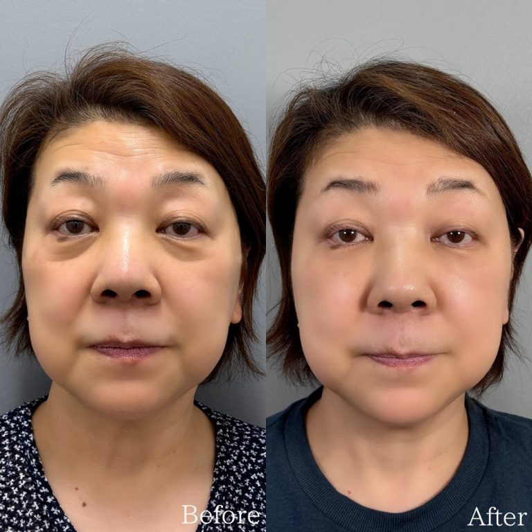 切らない目の下のクマ取り・目の下のたるみ（ふくらみ）取り(担当医:佐野 孝治 医師)の症例写真1