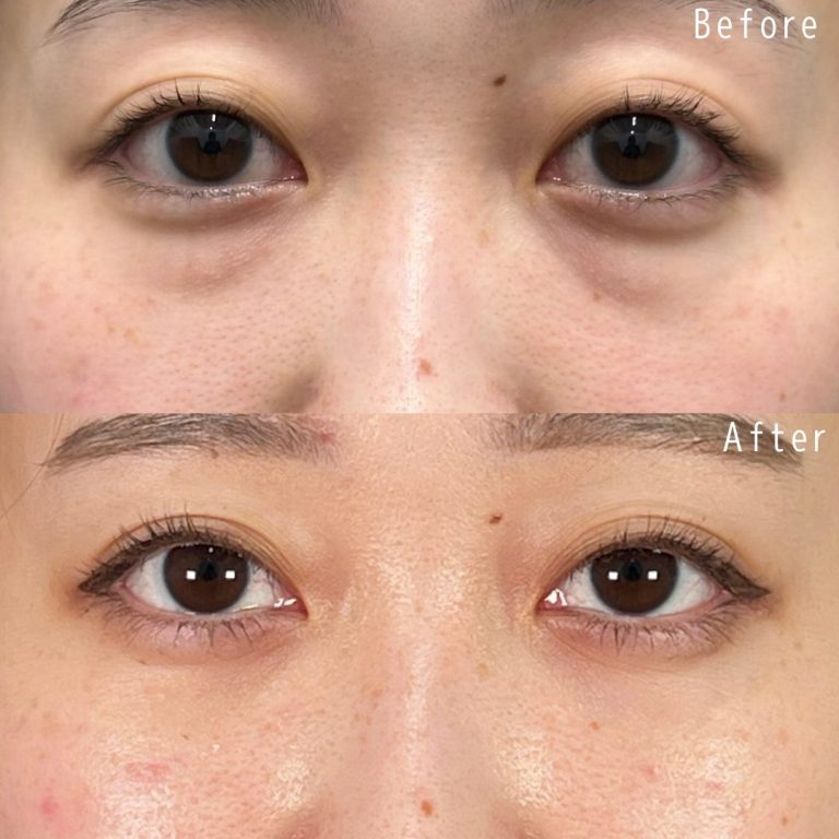 切らない目の下のクマ取り・目の下のたるみ（ふくらみ）取り(担当医:佐野 孝治 医師)の症例写真1