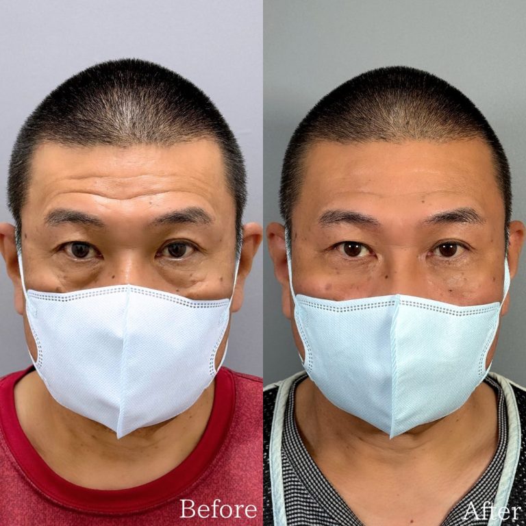切らない目の下のクマ取り・目の下のたるみ（ふくらみ）取り(担当医:佐野 孝治 医師)の症例写真1