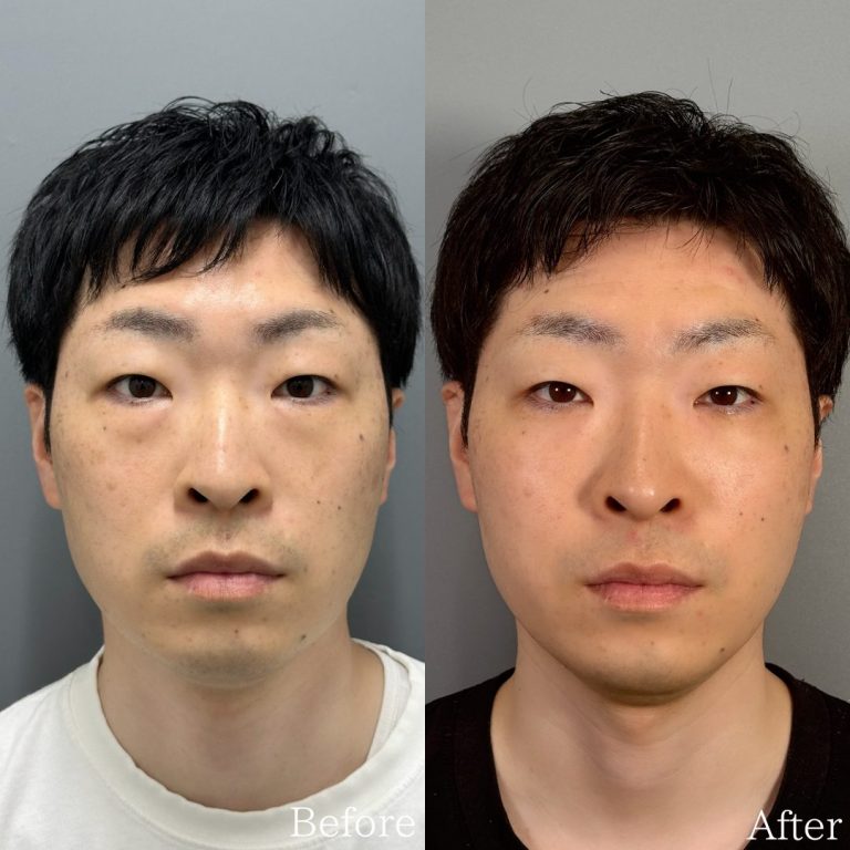 切らない目の下のクマ取り・目の下のたるみ（ふくらみ）取り(担当医:佐野 孝治 医師)の症例写真1