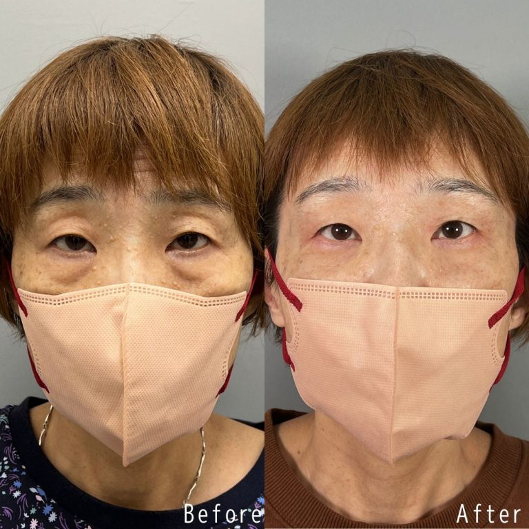 切らない目の下のクマ取り・目の下のたるみ（ふくらみ）取り(担当医:佐野 孝治 医師)の症例写真1