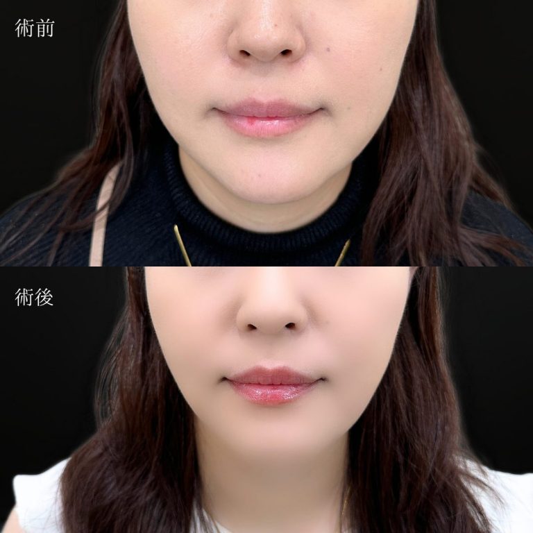 顔の脂肪吸引(担当医:三好 翔輝 医師)の症例写真1