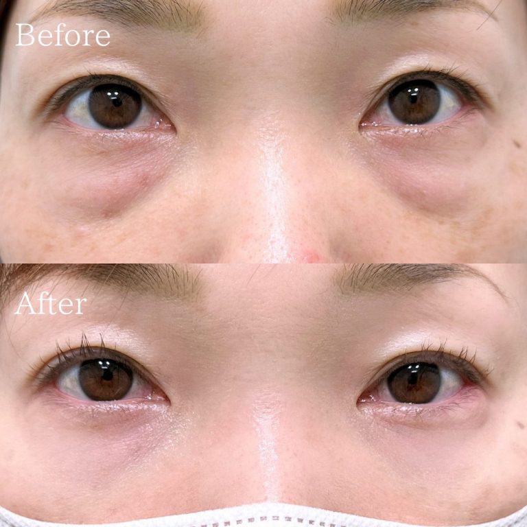 切らない目の下のクマ取り・目の下のたるみ（ふくらみ）取り(担当医:三好 翔輝 医師)の症例写真1