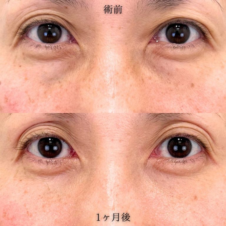 切らない目の下のクマ取り・目の下のたるみ（ふくらみ）取り(担当医:中川 由美子 医師)の症例写真1