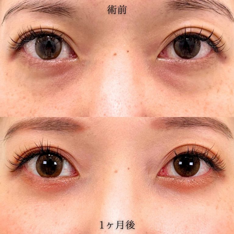 切らない目の下のクマ取り・目の下のたるみ（ふくらみ）取り(担当医:中川 由美子 医師)の症例写真1