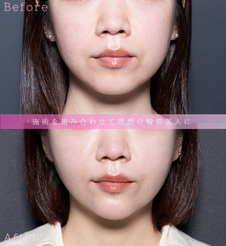 顔の脂肪吸引(担当医:北村 可恋 医師)の症例写真1