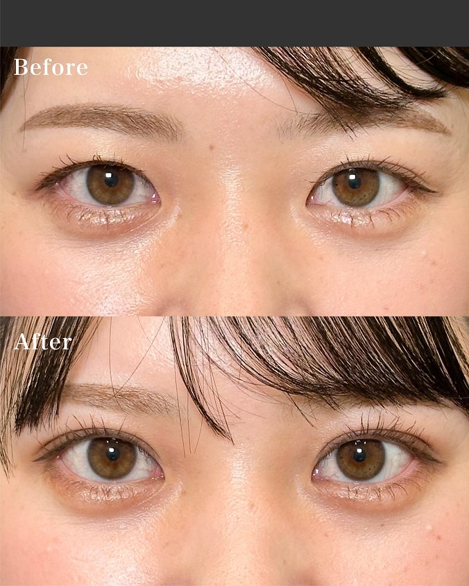 二重埋没法(担当医:岡本 卓也 医師)の症例写真1