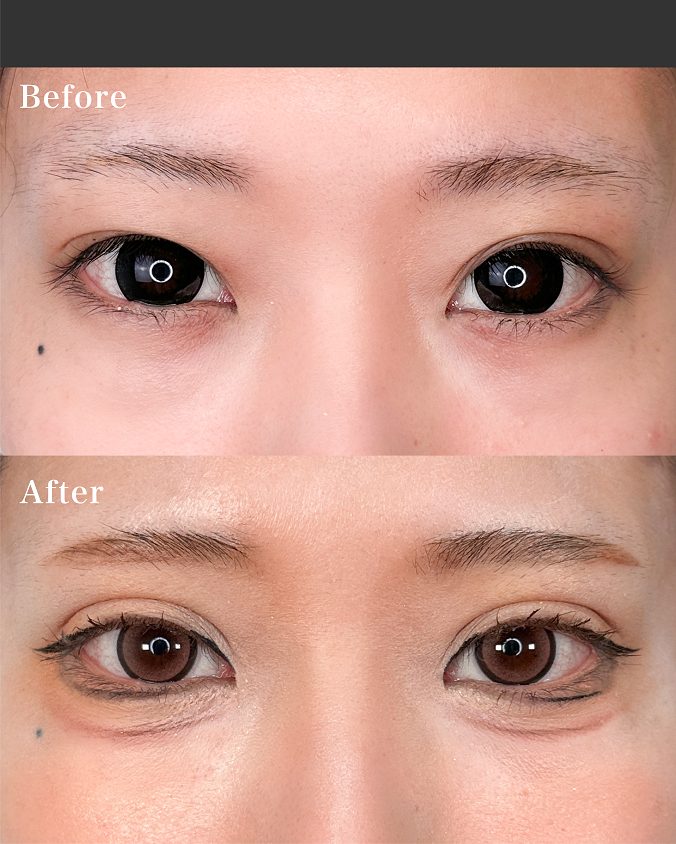 二重埋没法(担当医:岡本 卓也 医師)の症例写真1