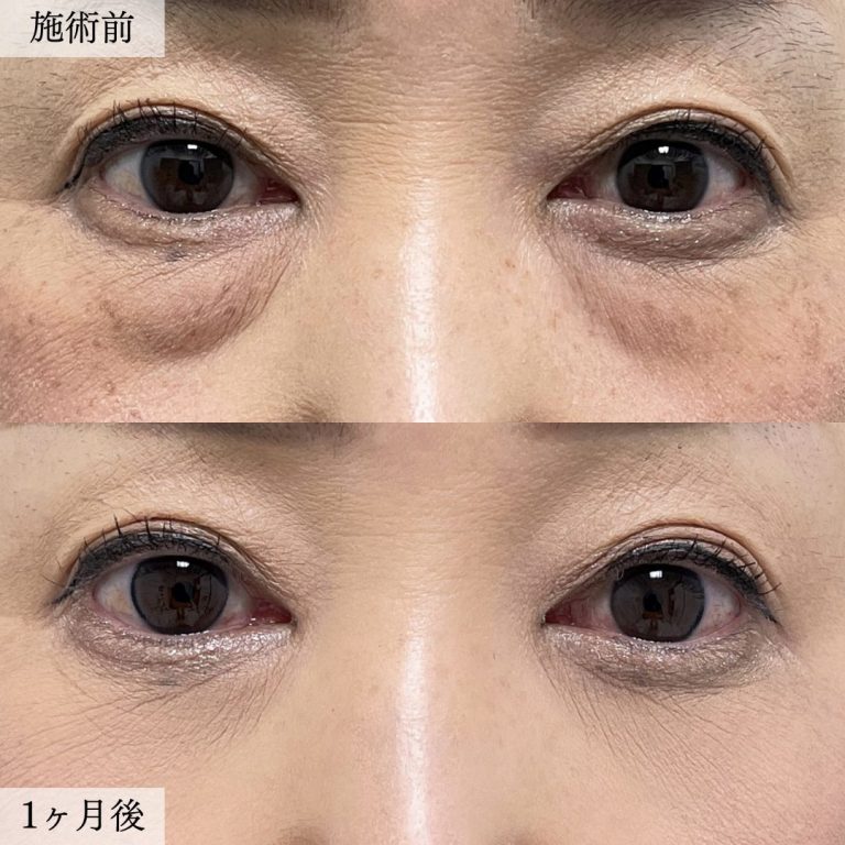 切らない目の下のクマ取り・目の下のたるみ（ふくらみ）取り(担当医:大見 貴秀 医師)の症例写真1