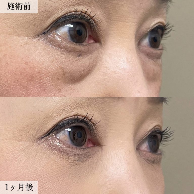 切らない目の下のクマ取り・目の下のたるみ（ふくらみ）取り(担当医:大見 貴秀 医師)の症例写真2