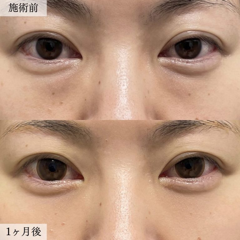 切らない目の下のクマ取り・目の下のたるみ（ふくらみ）取り(担当医:大見 貴秀 医師)の症例写真1