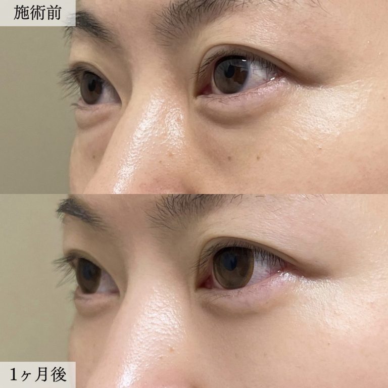 切らない目の下のクマ取り・目の下のたるみ（ふくらみ）取り(担当医:大見 貴秀 医師)の症例写真2