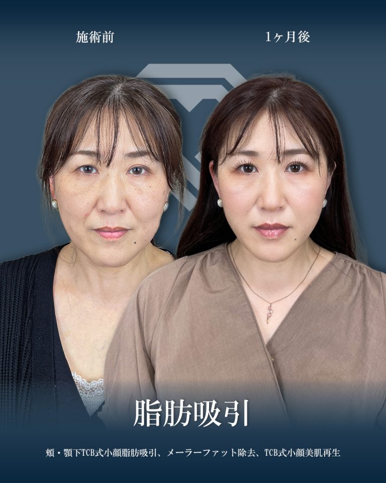 顔の脂肪吸引(担当医:大見 貴秀 医師)の症例写真1