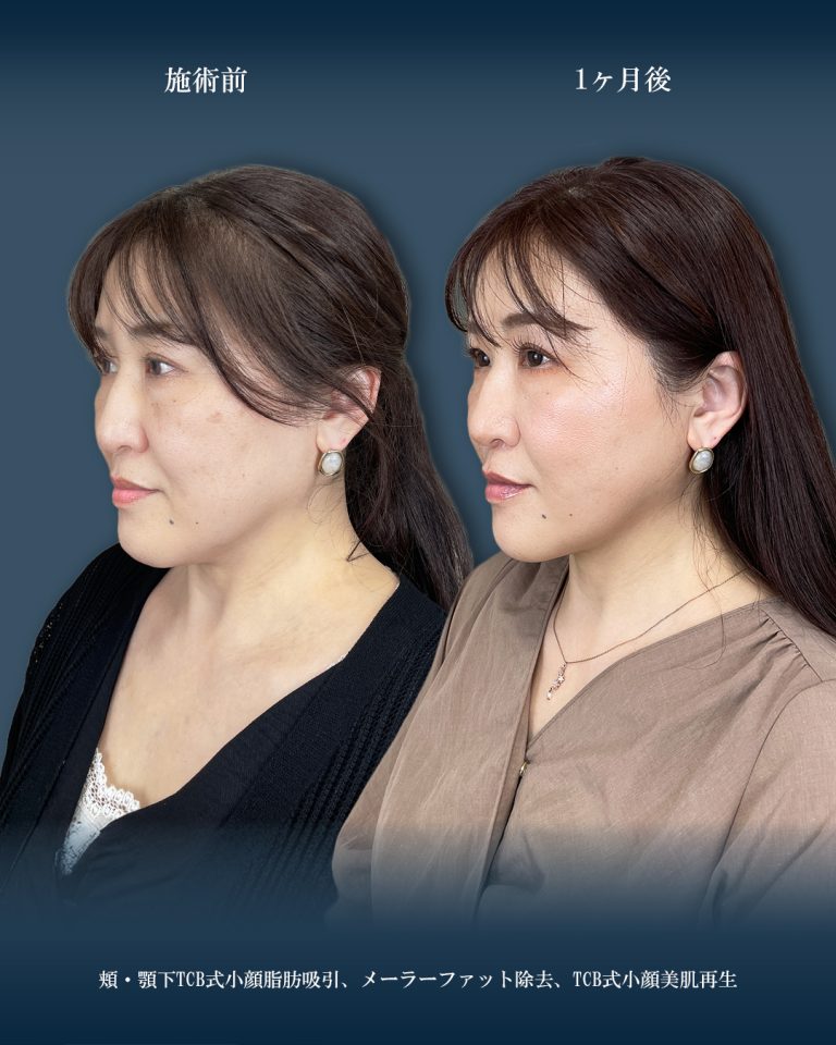 顔の脂肪吸引(担当医:大見 貴秀 医師)の症例写真2