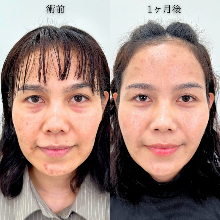 切らない目の下のクマ取り・目の下のたるみ（ふくらみ）取り(担当医:中川 由美子 医師)の症例写真1