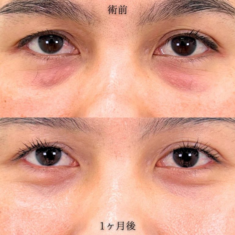 切らない目の下のクマ取り・目の下のたるみ（ふくらみ）取り(担当医:中川 由美子 医師)の症例写真2