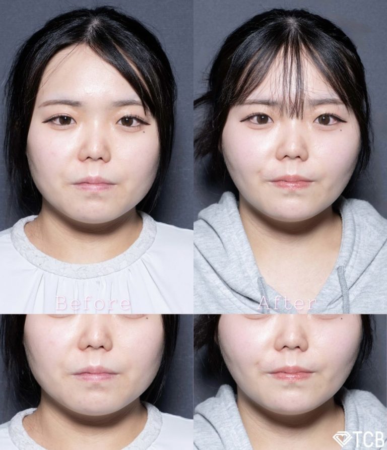 顔の脂肪吸引(担当医:北村 可恋 医師)の症例写真1