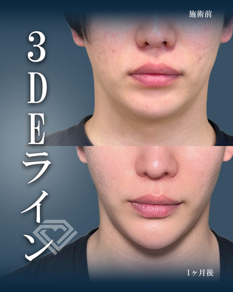 切らない顎形成 3D Eライン(担当医:大見 貴秀 医師)の症例写真1