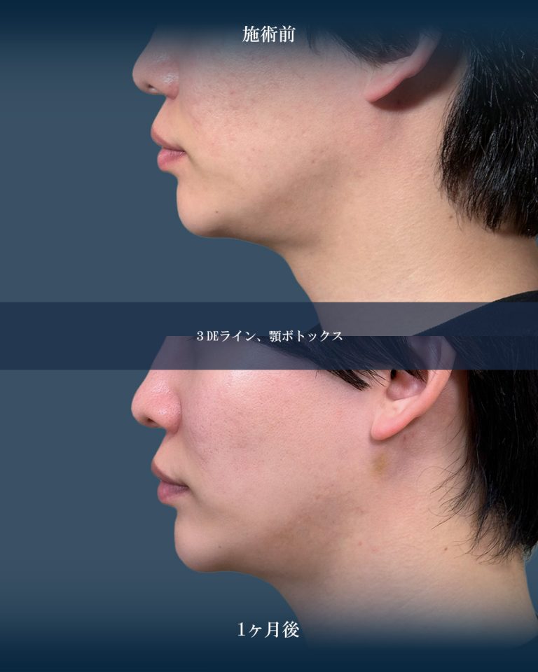 切らない顎形成 3D Eライン(担当医:大見 貴秀 医師)の症例写真3