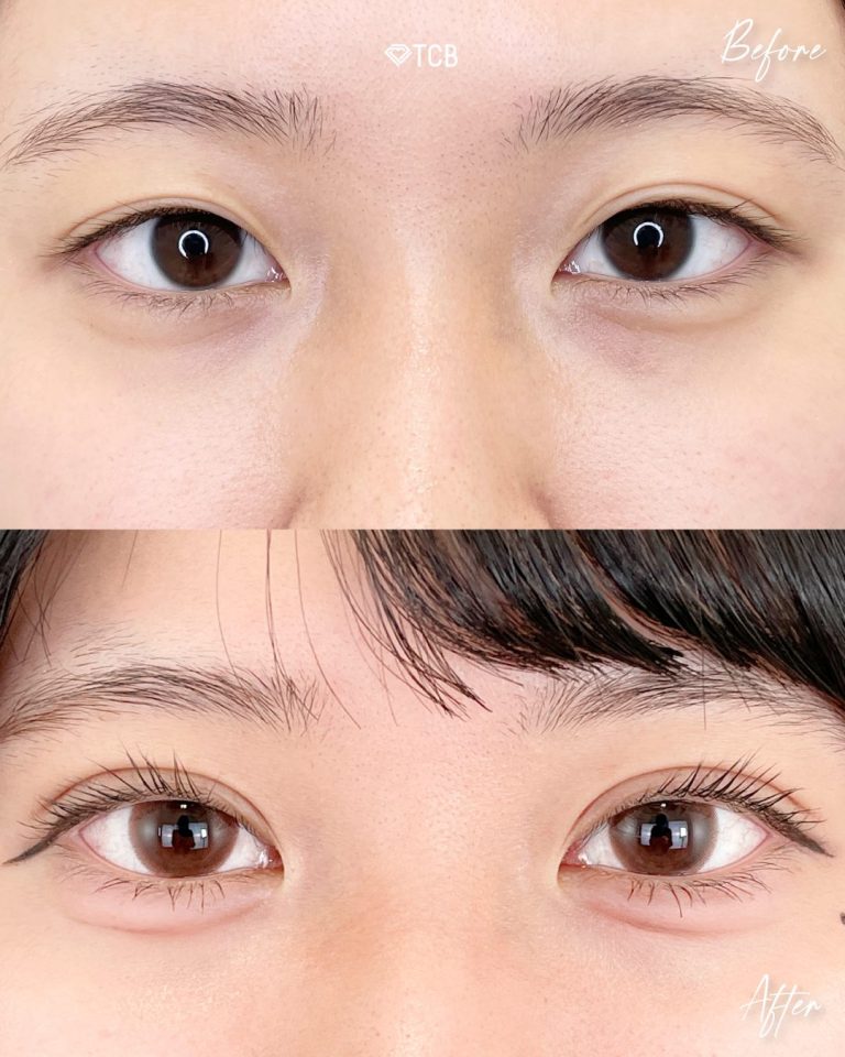 涙袋形成（ヒアルロン酸注射）(担当医:向田 敦史 医師)の症例写真1