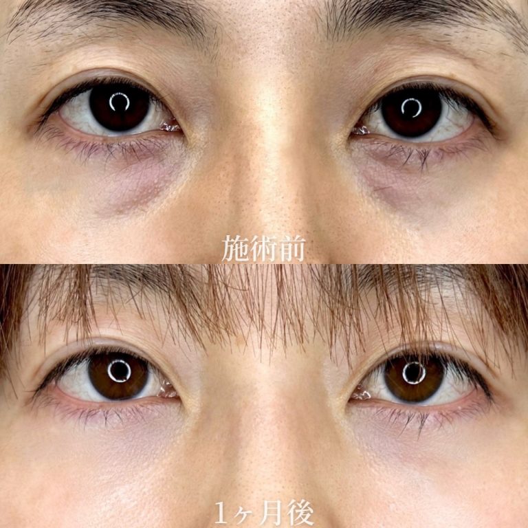 切らない目の下のクマ取り・目の下のたるみ（ふくらみ）取り(担当医:垣花 瑠美子 医師)の症例写真1
