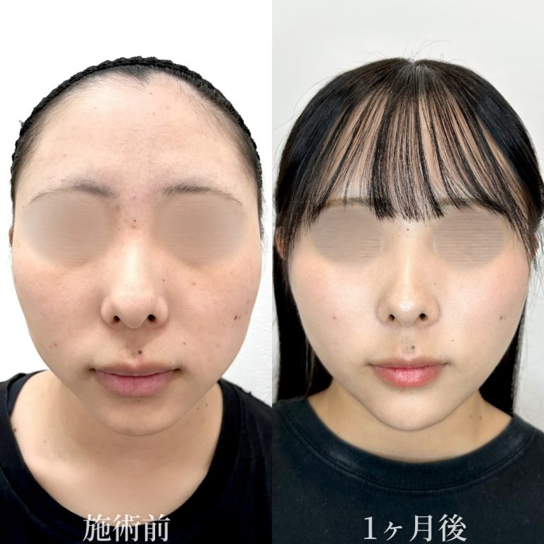 小顔美肌再生（リフトアップ）(担当医:垣花 瑠美子 医師)の症例写真1