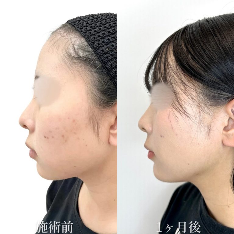 小顔美肌再生（リフトアップ）(担当医:垣花 瑠美子 医師)の症例写真2