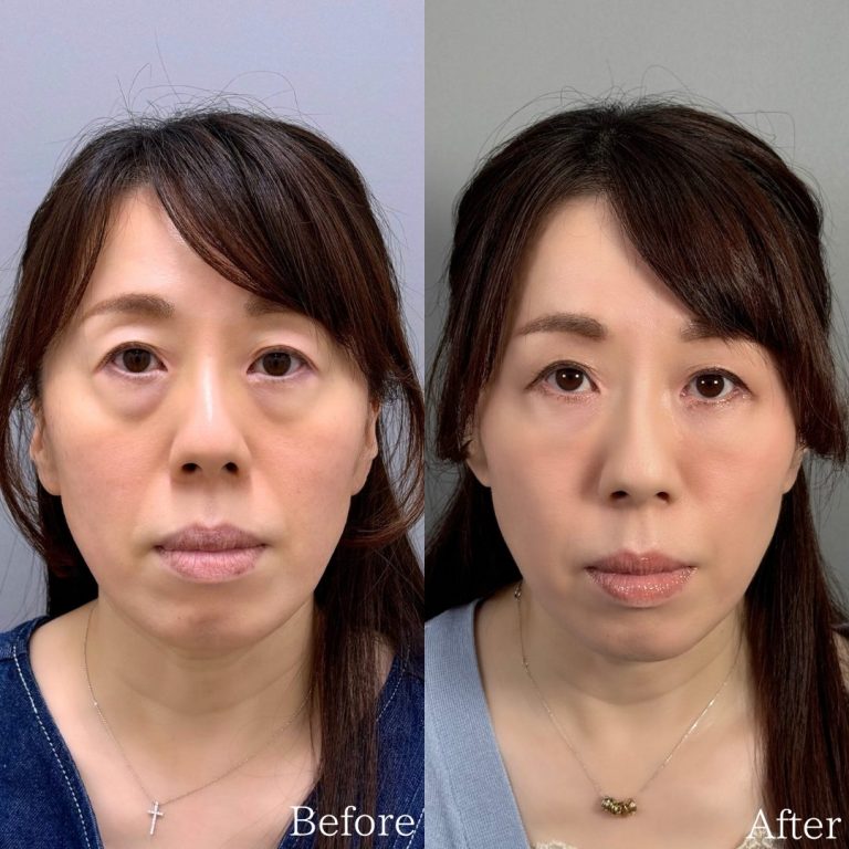 切らない目の下のクマ取り・目の下のたるみ（ふくらみ）取り(担当医:佐野 孝治 医師)の症例写真1
