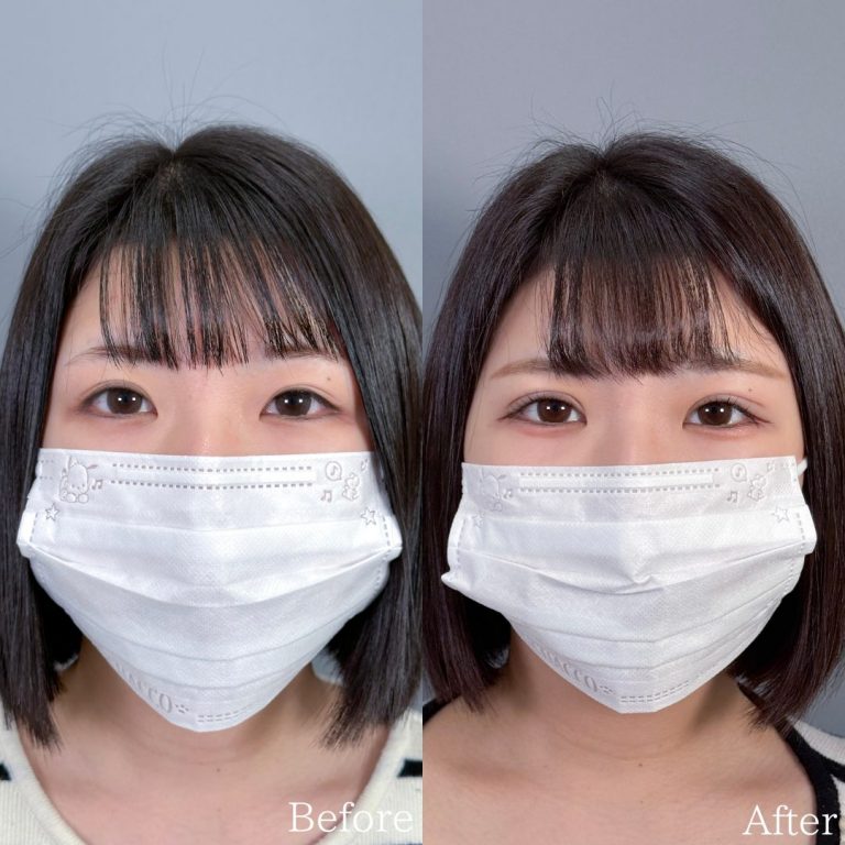 二重埋没法(担当医:佐野 孝治 医師)の症例写真1