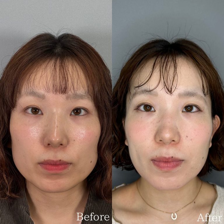 小顔美肌再生（リフトアップ）(担当医:佐野 孝治 医師)の症例写真1