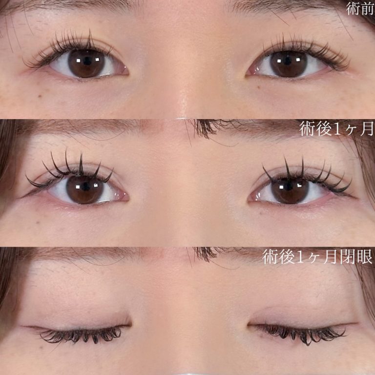 二重埋没法(担当医:佐野 孝治 医師)の症例写真1