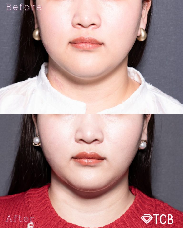 顔の脂肪吸引(担当医:北村 可恋 医師)の症例写真1