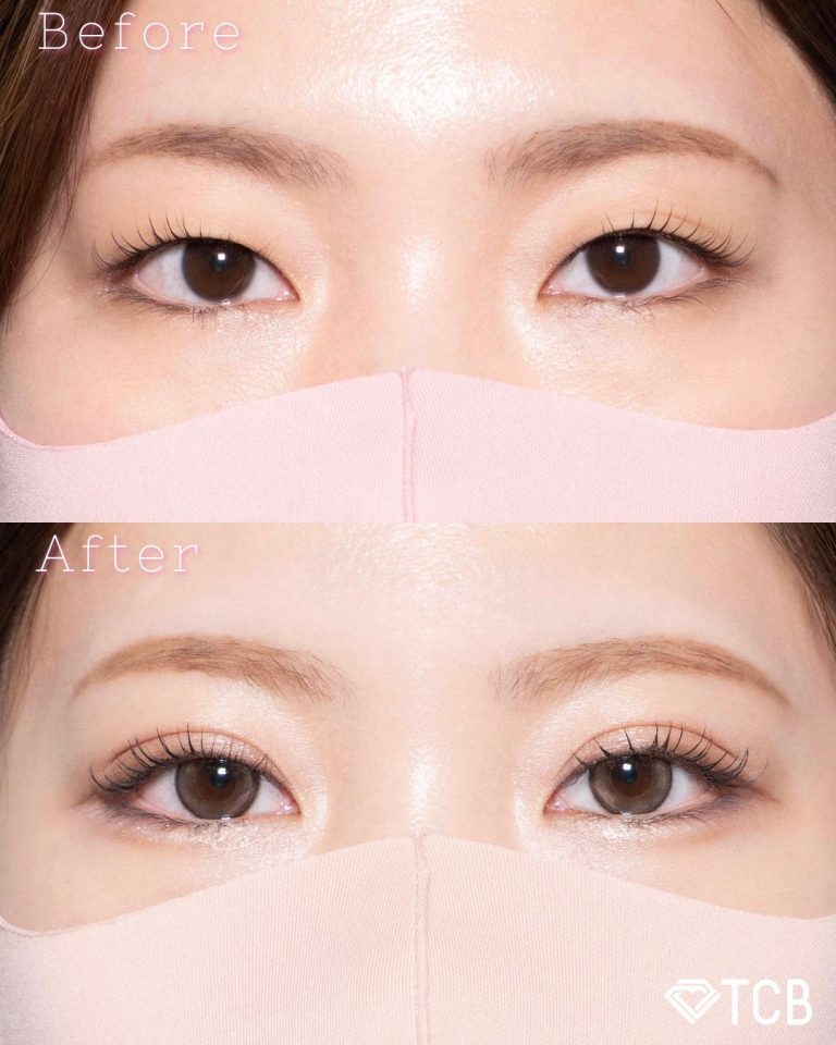 二重埋没法(担当医:北村 可恋 医師)の症例写真1