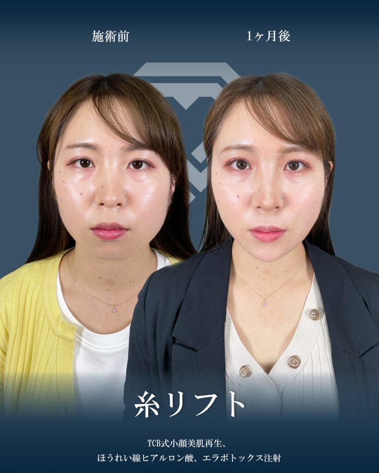 小顔美肌再生（リフトアップ）(担当医:大見 貴秀 医師)の症例写真1
