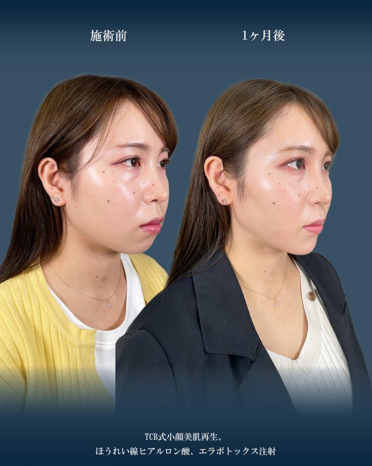 小顔美肌再生（リフトアップ）(担当医:大見 貴秀 医師)の症例写真2