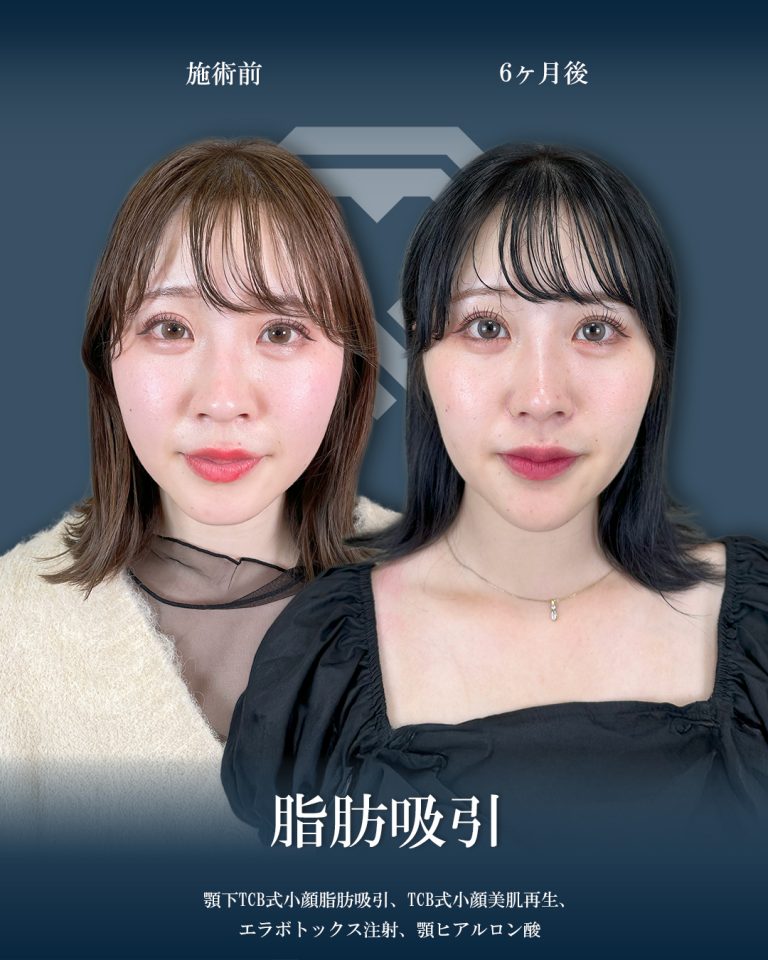 顔の脂肪吸引(担当医:大見 貴秀 医師)の症例写真1