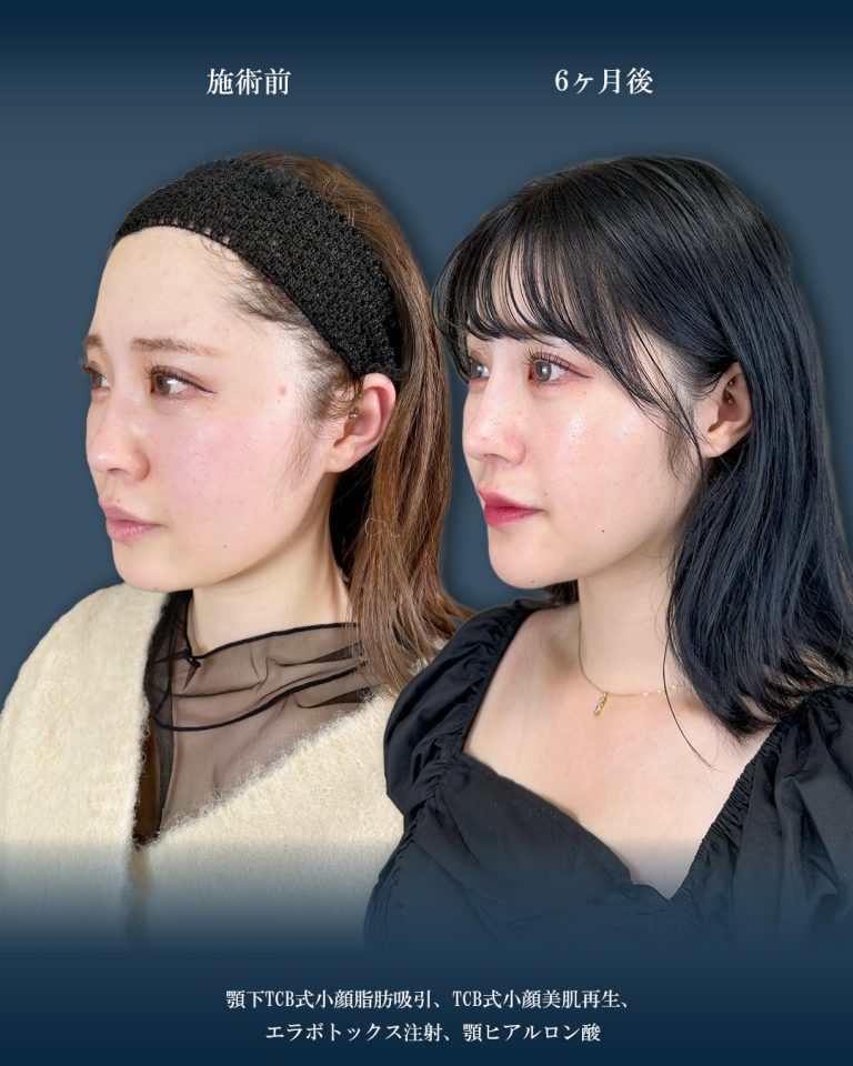 顔の脂肪吸引(担当医:大見 貴秀 医師)の症例写真2