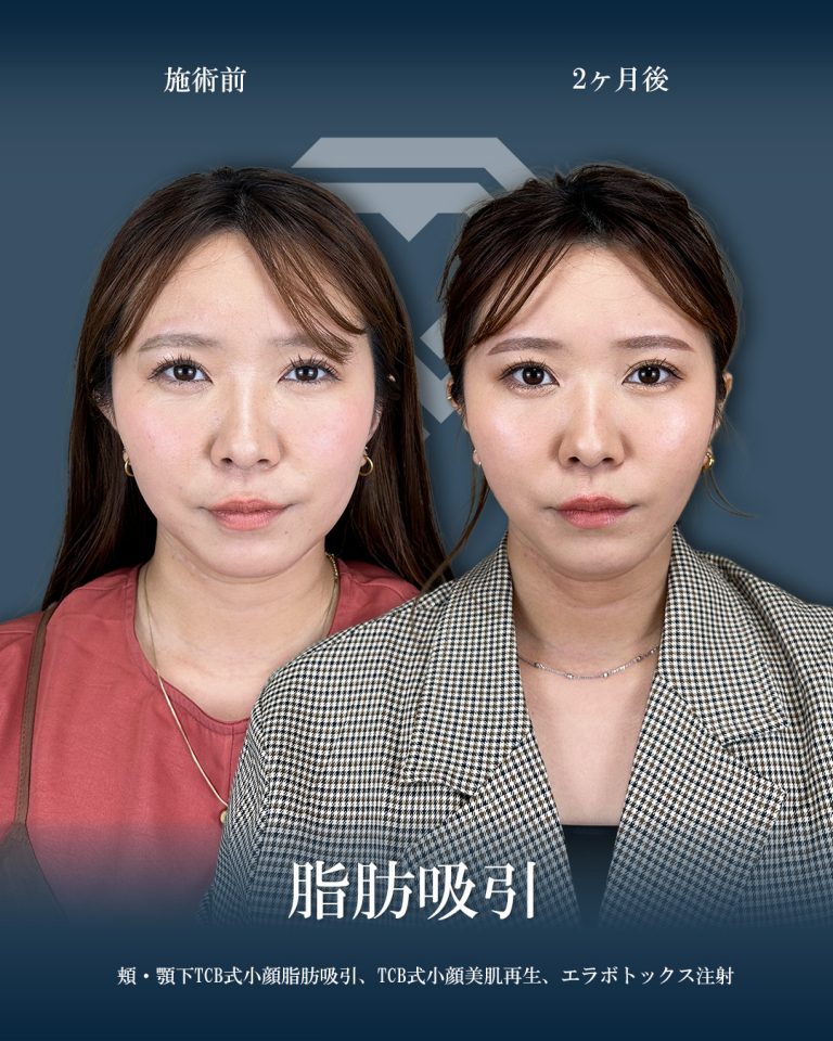 顔の脂肪吸引(担当医:大見 貴秀 医師)の症例写真1