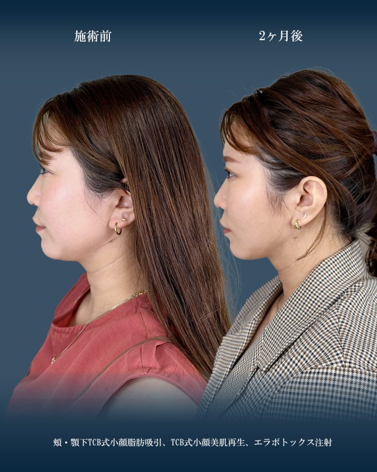 顔の脂肪吸引(担当医:大見 貴秀 医師)の症例写真2