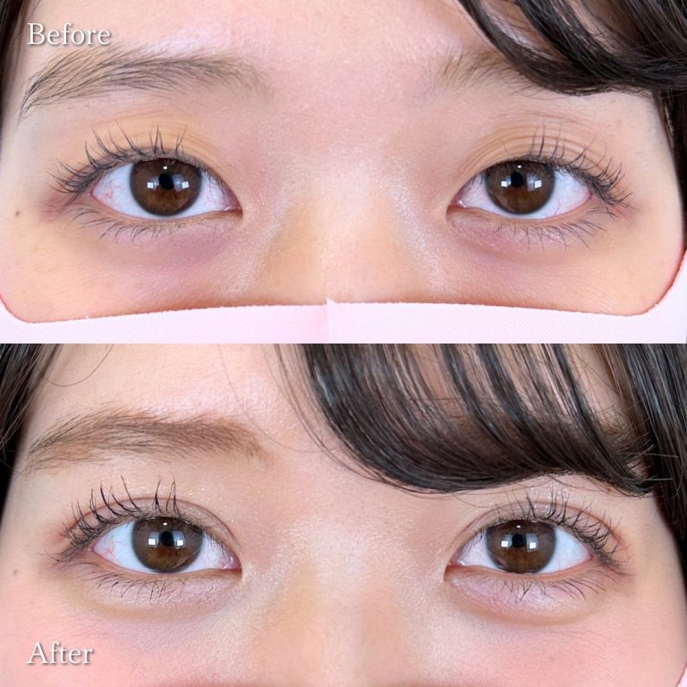 二重埋没法(担当医:向田 敦史 医師)の症例写真1