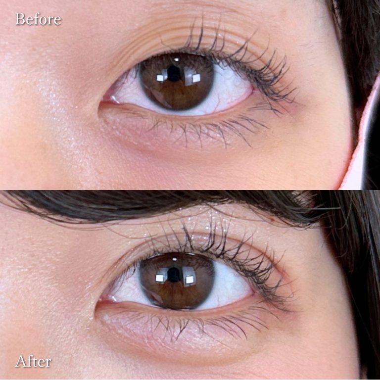 二重埋没法(担当医:向田 敦史 医師)の症例写真2