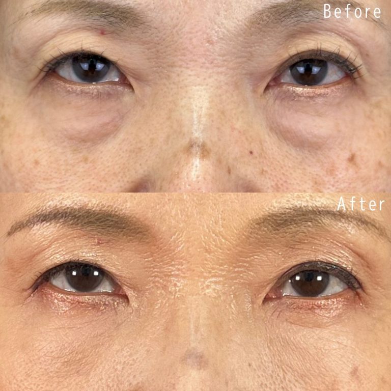 切らない目の下のクマ取り・目の下のたるみ（ふくらみ）取り(担当医:佐野 孝治 医師)の症例写真1